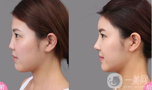 自體隆鼻價格是多少 *果好不好？