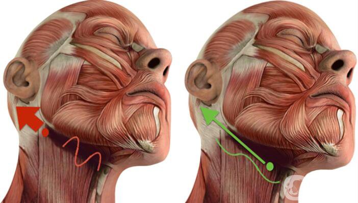 頸部松弛怎么辦 微創(chuàng)頸年輕化手術(shù)-聚四氟乙烯(PTFE)除皺術(shù)