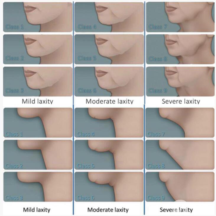 頸部松弛怎么辦 微創(chuàng)頸年輕化手術(shù)-聚四氟乙烯(PTFE)除皺術(shù)