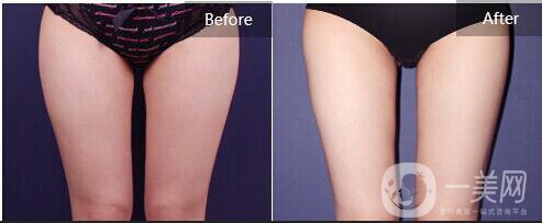 光纖溶脂大腿多少錢,光纖溶脂大腿注意事項