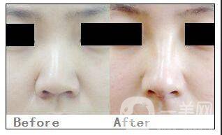 鼻小柱延長價(jià)格,鼻小柱延長*果
