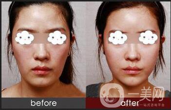 自體脂肪面部填充利弊