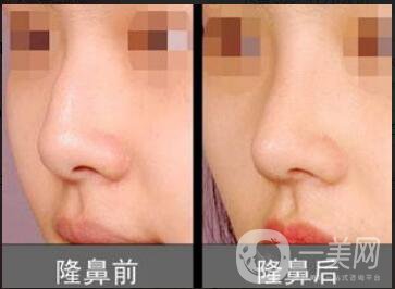 隆鼻手多少錢,隆鼻貴不貴