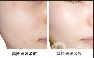 黑臉娃娃*果,黑臉娃娃副作用