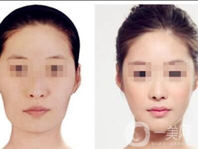 顴骨吸脂,顴骨吸脂注意事項(xiàng)