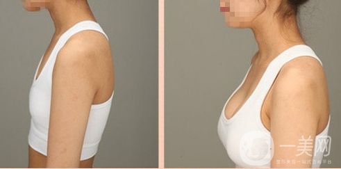 假體豐胸有什么后遺癥嗎 后遺癥嚴(yán)重嗎？