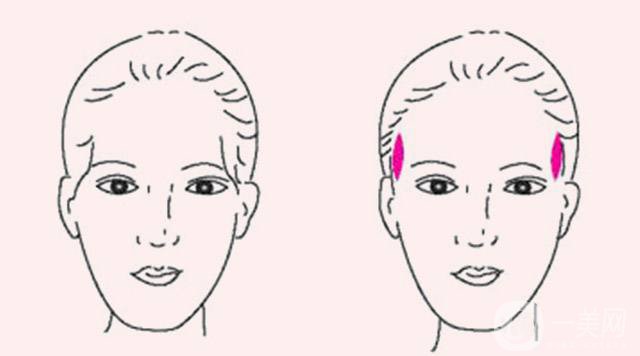 玻尿酸豐太陽穴報(bào)價(jià) 玻尿酸豐太陽穴的方法
