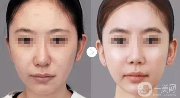 *注射適宜人群有哪些 *果怎么樣？