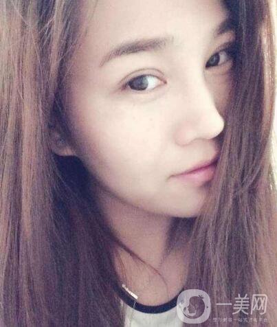 韓國(guó)做雙眼皮手術(shù)常見的5個(gè)問題解答