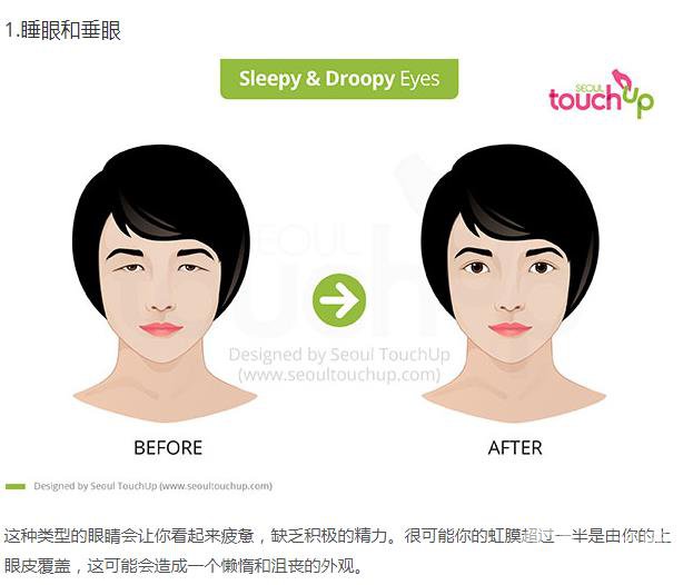 韓國(guó)做雙眼皮手術(shù)常見的5個(gè)問題解答