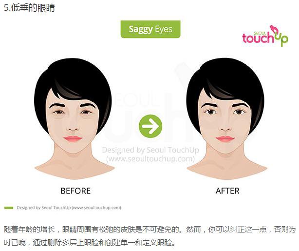 韓國(guó)做雙眼皮手術(shù)常見的5個(gè)問題解答