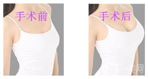 假體隆胸的恢復(fù)時(shí)間是多久？