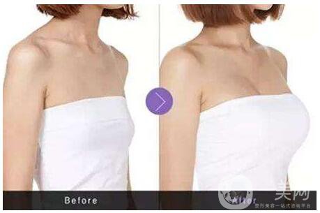 隆胸選擇哪種材料*好？隆胸醫(yī)生教你選擇！