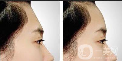 膨體豐額頭, 膨體豐額頭價格