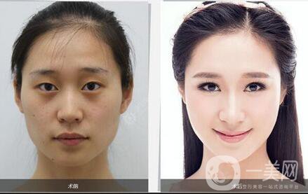 自體脂肪面部填充術(shù)前準(zhǔn)備