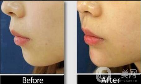 下巴注射玻尿酸,注射玻尿酸術后注意事項