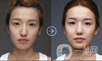 面部脂肪填充價格,面部脂肪填充貴不貴