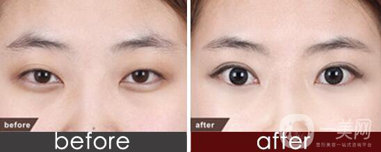 全切雙眼皮,全切雙眼皮需要拆線嗎,全切雙眼皮術(shù)后注意事項(xiàng)