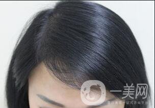 發(fā)際線種植恢復(fù)期