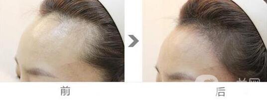 發(fā)際線種植恢復(fù)期