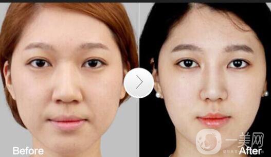 鼻翼縮小多少錢,鼻翼縮小術后護理