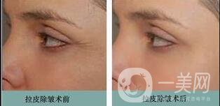 拉皮手術(shù)多久恢復(fù),拉皮手術(shù)注意事項