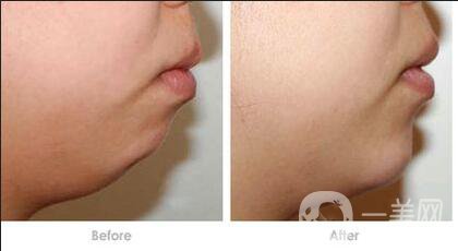 下巴吸脂多久恢復,下巴吸脂術后護理方式
