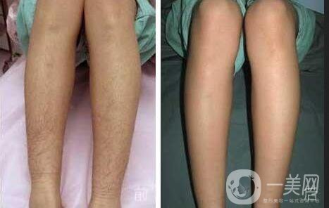 大腿激光脫毛價格