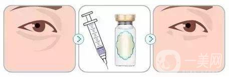 玻尿酸能填充淚溝嗎 玻尿酸手術(shù)*果