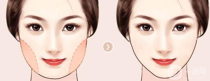 吸脂瘦臉手術(shù)大概多少錢 吸脂瘦臉有風(fēng)險嗎