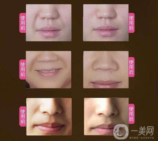 玻尿酸去法令紋的價(jià)錢 時(shí)間保持久嗎？