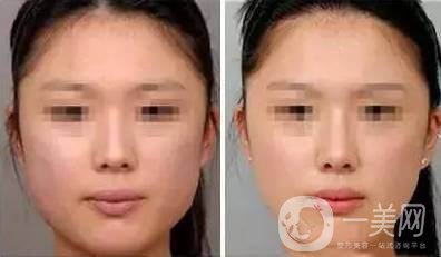 深圳臉部溶脂多少錢 臉部溶脂的好處