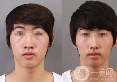 鼻翼縮小手術(shù)價(jià)格 鼻翼縮小方法