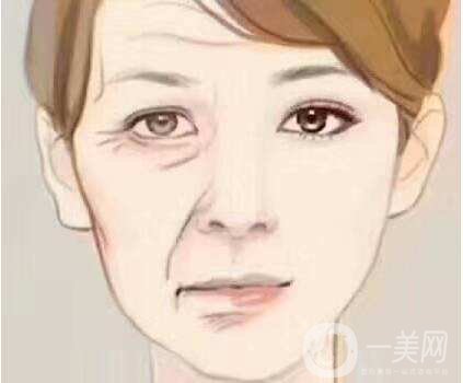 玻尿酸去法令紋價(jià)格是多少 去法令紋方法