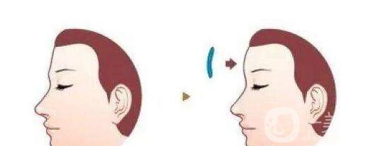 硅膠豐額頭貴嗎 硅膠豐額頭材料有哪些？