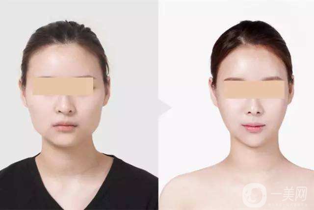 微創(chuàng)改臉型多少錢 改臉型的壞處