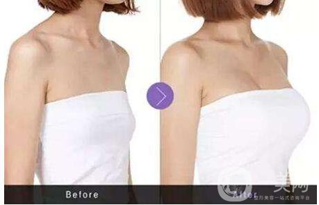 妙桃隆胸的價(jià)格 妙桃隆胸*果怎么樣