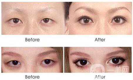 什么是芭比眼平行雙眼皮？