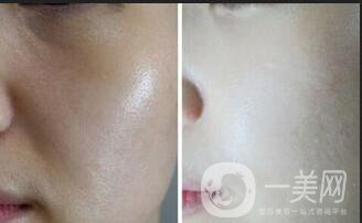 光子嫩膚價(jià)格