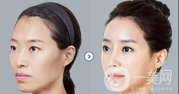 自體脂肪填充后遺癥