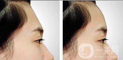 自體脂肪面部填充*果