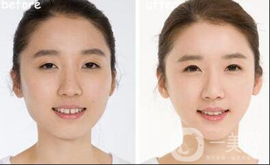 顴骨降低貴嗎,顴骨降低多少錢