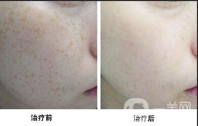 激光祛除黃褐斑*果,激光祛除黃褐斑注意事項(xiàng)
