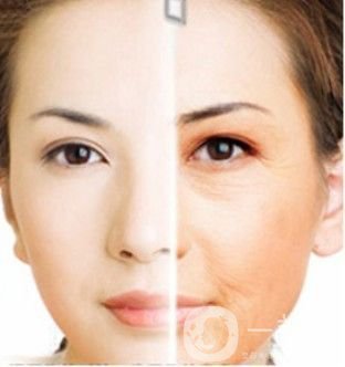 prt是什么 是電波拉皮嗎？