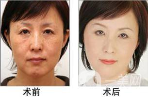 光子嫩膚適合人群 光子嫩膚的方法