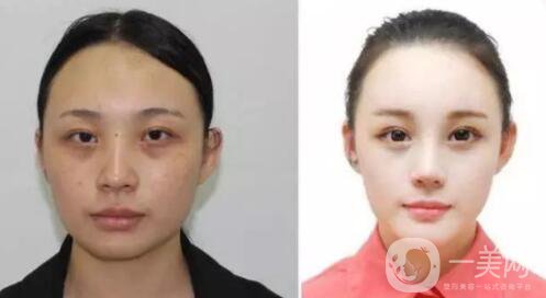 光子嫩膚的優(yōu)勢(shì) 光子嫩膚有風(fēng)險(xiǎn)嗎？