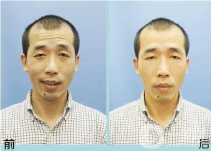 抬頭紋很深怎么辦 玻尿酸去抬頭紋怎么樣