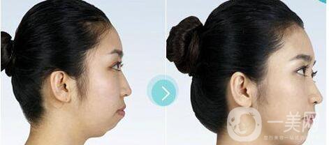 墊下巴前后圖 墊下巴的方法有哪些