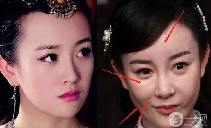 明星整容就是不承認(rèn)？ 然后突然臉“爛”了！