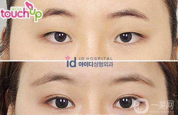 雙眼皮手術(shù)大解讀！